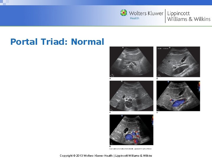Portal Triad: Normal Copyright © 2013 Wolters Kluwer Health | Lippincott Williams & Wilkins