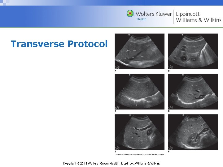 Transverse Protocol Copyright © 2013 Wolters Kluwer Health | Lippincott Williams & Wilkins 