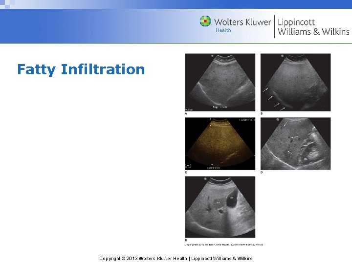 Fatty Infiltration Copyright © 2013 Wolters Kluwer Health | Lippincott Williams & Wilkins 