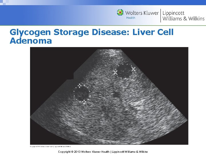Glycogen Storage Disease: Liver Cell Adenoma Copyright © 2013 Wolters Kluwer Health | Lippincott