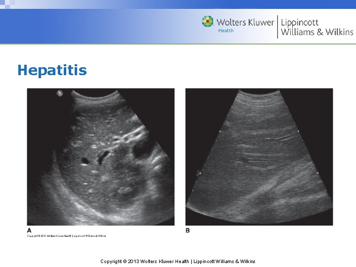Hepatitis Copyright © 2013 Wolters Kluwer Health | Lippincott Williams & Wilkins 