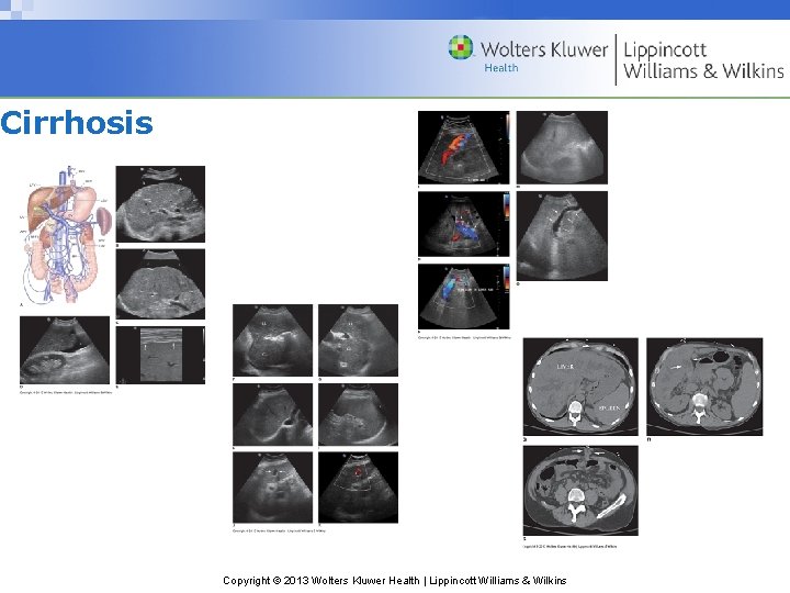 Cirrhosis Copyright © 2013 Wolters Kluwer Health | Lippincott Williams & Wilkins 