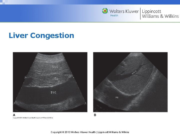Liver Congestion Copyright © 2013 Wolters Kluwer Health | Lippincott Williams & Wilkins 