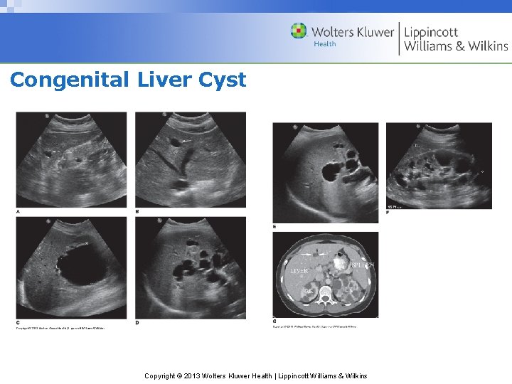 Congenital Liver Cyst Copyright © 2013 Wolters Kluwer Health | Lippincott Williams & Wilkins