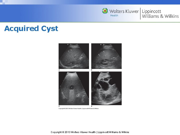 Acquired Cyst Copyright © 2013 Wolters Kluwer Health | Lippincott Williams & Wilkins 