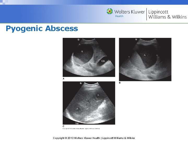 Pyogenic Abscess Copyright © 2013 Wolters Kluwer Health | Lippincott Williams & Wilkins 