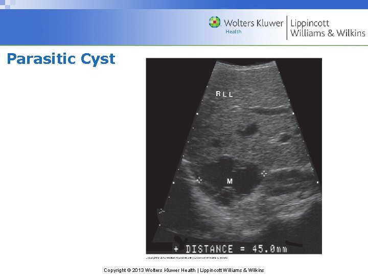 Parasitic Cyst Copyright © 2013 Wolters Kluwer Health | Lippincott Williams & Wilkins 