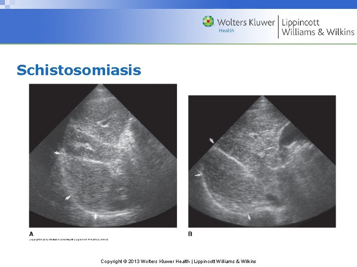 Schistosomiasis Copyright © 2013 Wolters Kluwer Health | Lippincott Williams & Wilkins 