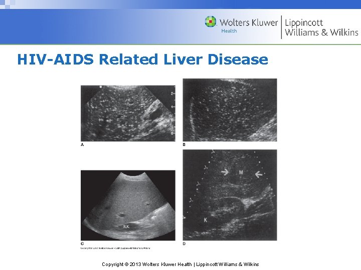 HIV-AIDS Related Liver Disease Copyright © 2013 Wolters Kluwer Health | Lippincott Williams &