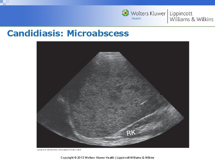 Candidiasis: Microabscess Copyright © 2013 Wolters Kluwer Health | Lippincott Williams & Wilkins 