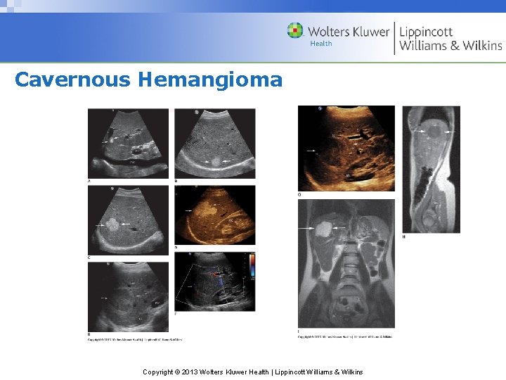 Cavernous Hemangioma Copyright © 2013 Wolters Kluwer Health | Lippincott Williams & Wilkins 
