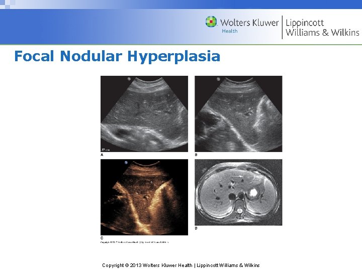 Focal Nodular Hyperplasia Copyright © 2013 Wolters Kluwer Health | Lippincott Williams & Wilkins