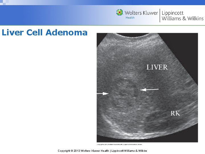 Liver Cell Adenoma Copyright © 2013 Wolters Kluwer Health | Lippincott Williams & Wilkins