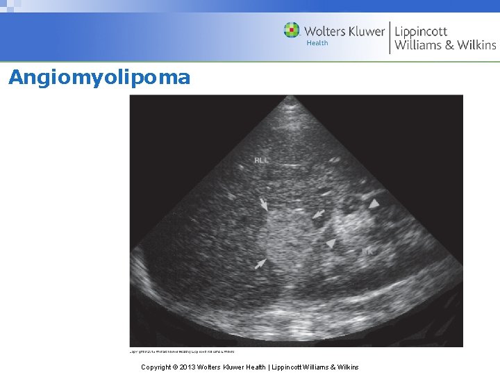 Angiomyolipoma Copyright © 2013 Wolters Kluwer Health | Lippincott Williams & Wilkins 