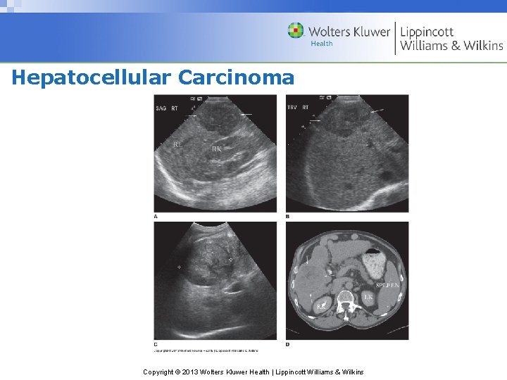 Hepatocellular Carcinoma Copyright © 2013 Wolters Kluwer Health | Lippincott Williams & Wilkins 