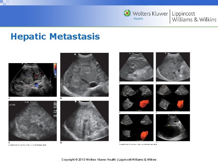 Hepatic Metastasis Copyright © 2013 Wolters Kluwer Health | Lippincott Williams & Wilkins 