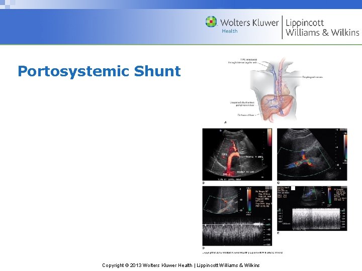 Portosystemic Shunt Copyright © 2013 Wolters Kluwer Health | Lippincott Williams & Wilkins 