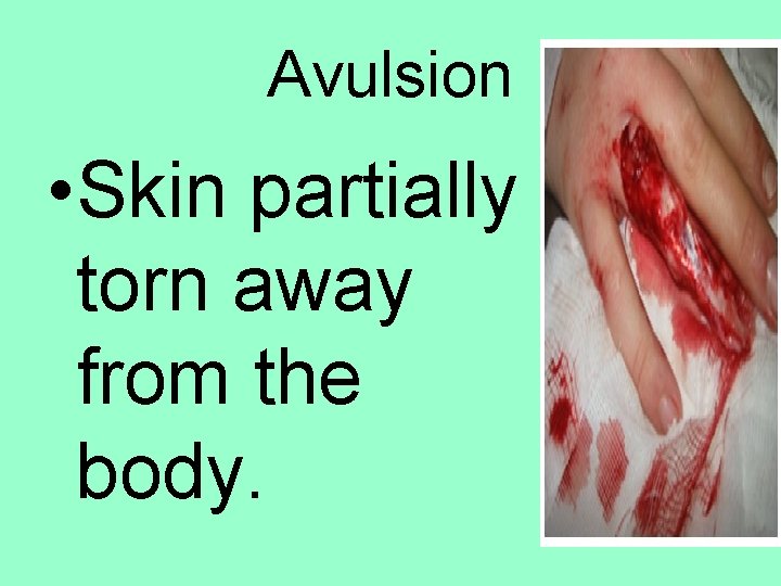 Avulsion • Skin partially torn away from the body. 