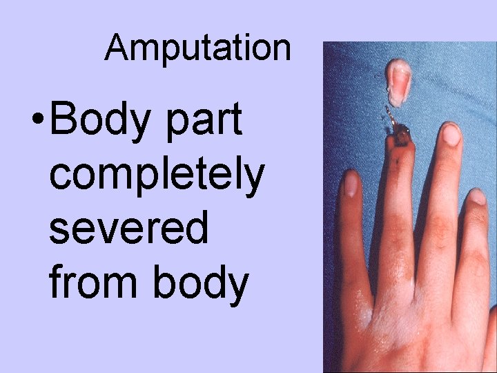 Amputation • Body part completely severed from body 