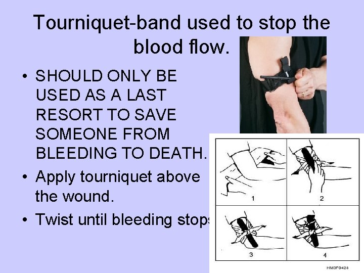 Tourniquet-band used to stop the blood flow. • SHOULD ONLY BE USED AS A