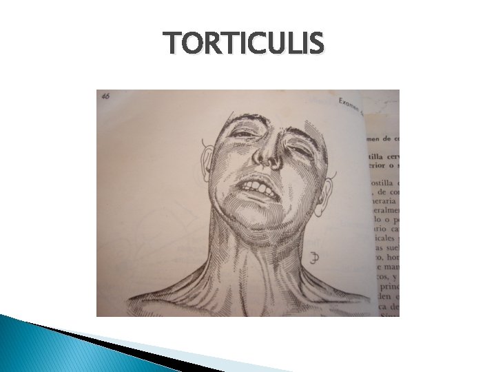 TORTICULIS 
