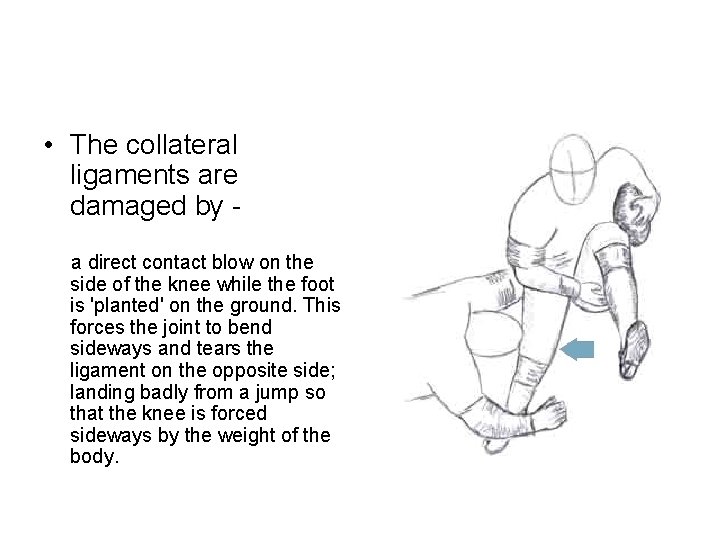  • The collateral ligaments are damaged by a direct contact blow on the