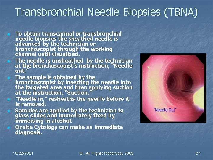 Transbronchial Needle Biopsies (TBNA) n n n To obtain transcarinal or transbronchial needle biopsies