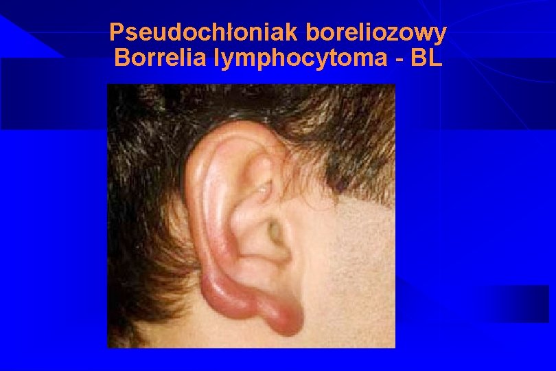 Pseudochłoniak boreliozowy Borrelia lymphocytoma - BL 