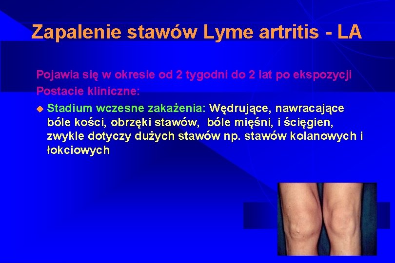 Zapalenie stawów Lyme artritis - LA Pojawia się w okresie od 2 tygodni do