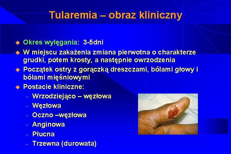Tularemia – obraz kliniczny u u Okres wylęgania: 3 -5 dni W miejscu zakażenia