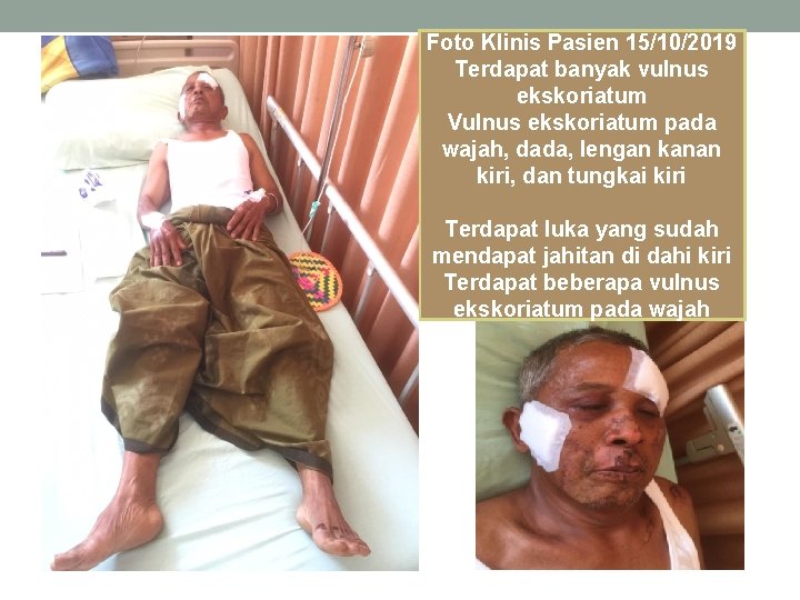 Foto Klinis Pasien 15/10/2019 Terdapat banyak vulnus ekskoriatum Vulnus ekskoriatum pada wajah, dada, lengan