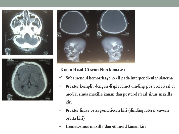 Kesan Head Ct scan Non kontras: Subaracnoid hemorrhage kecil pada interpendicular sisterna Fraktur komplit