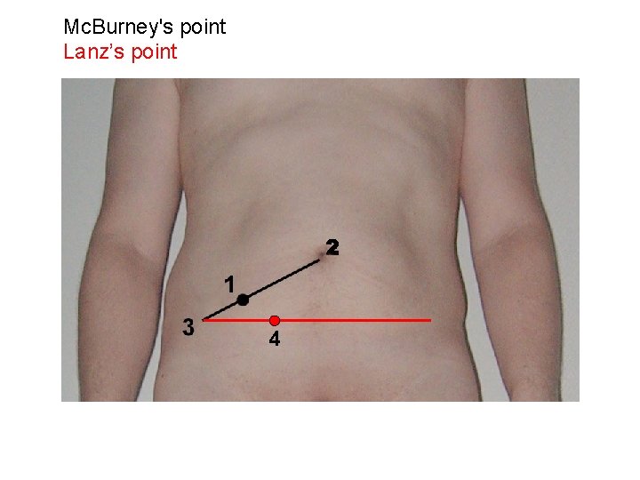 Mc. Burney's point Lanz’s point 4 