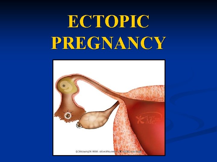 ECTOPIC PREGNANCY 