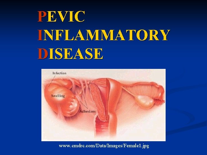 PEVIC INFLAMMATORY DISEASE www. cmdrc. com/Data/Images/Female 1. jpg 