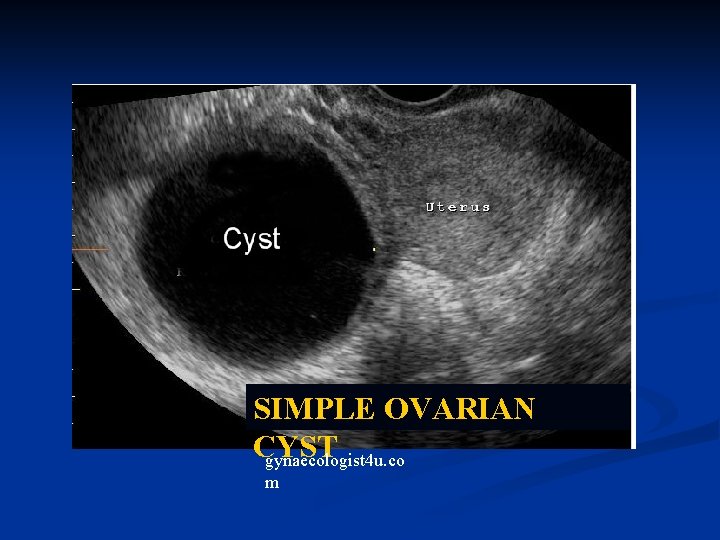 SIMPLE OVARIAN CYST gynaecologist 4 u. co m 
