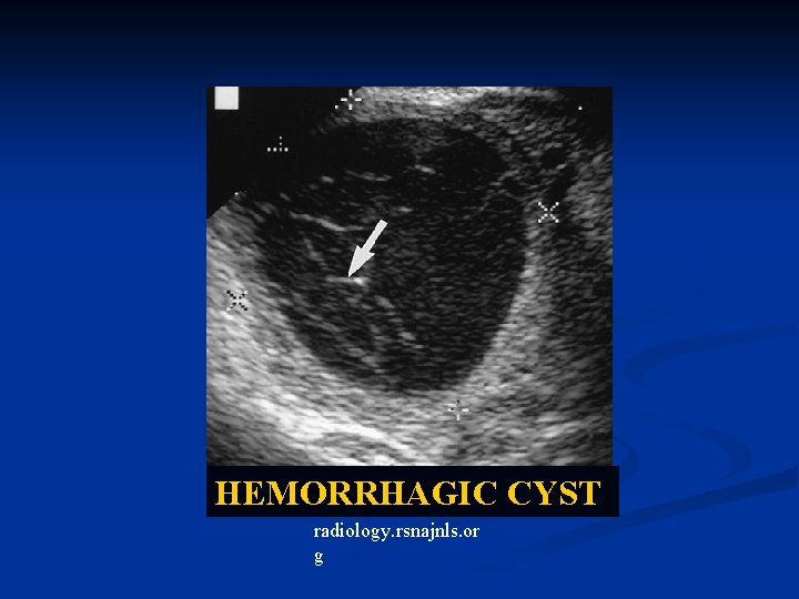 HEMORRHAGIC CYST radiology. rsnajnls. or g 