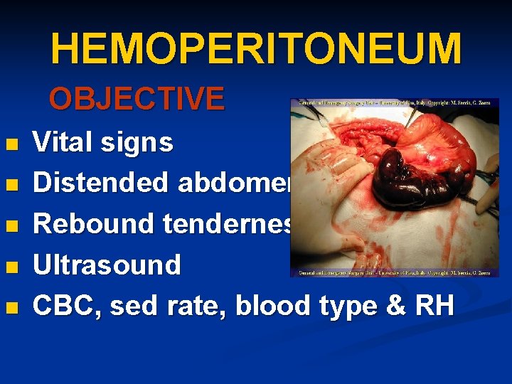 HEMOPERITONEUM OBJECTIVE n n n Vital signs Distended abdomen Rebound tenderness Ultrasound CBC, sed