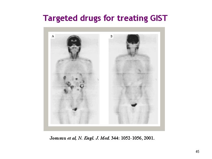 Targeted drugs for treating GIST Joensuu et al, N. Engl. J. Med. 344: 1052