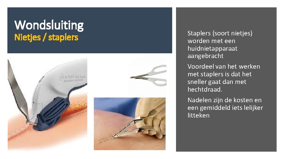 Wondsluiting Nietjes / staplers Staplers (soort nietjes) worden met een huidnietapparaat aangebracht Voordeel van