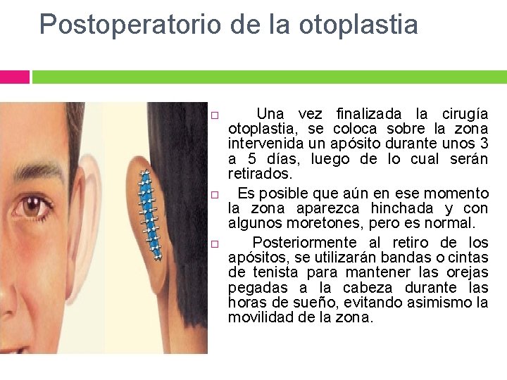 Postoperatorio de la otoplastia Una vez finalizada la cirugía otoplastia, se coloca sobre la