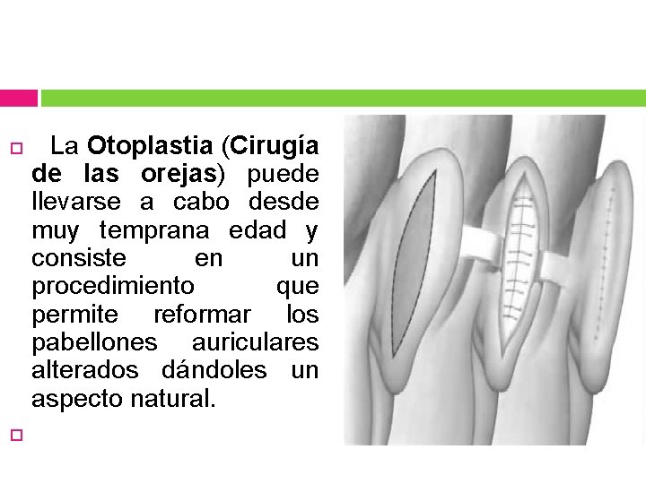  La Otoplastia (Cirugía de las orejas) puede llevarse a cabo desde muy temprana