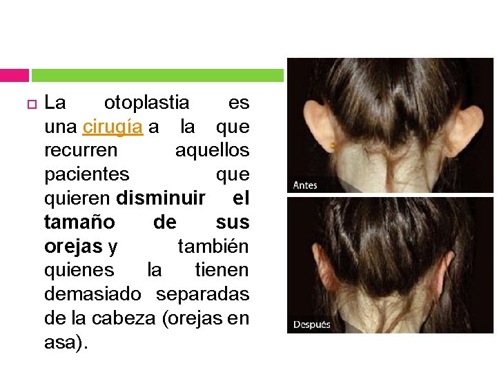  La otoplastia es una cirugía a la que recurren aquellos pacientes que quieren