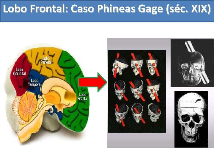 Lobo Frontal: Caso Phineas Gage (séc. XIX) 