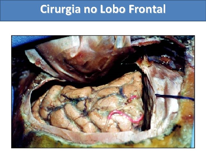 Cirurgia no Lobo Frontal 