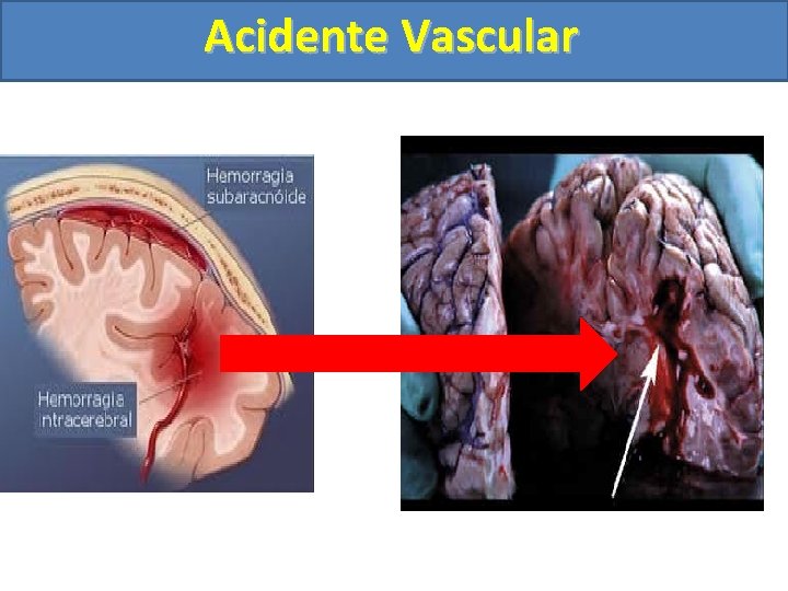 Acidente Vascular 