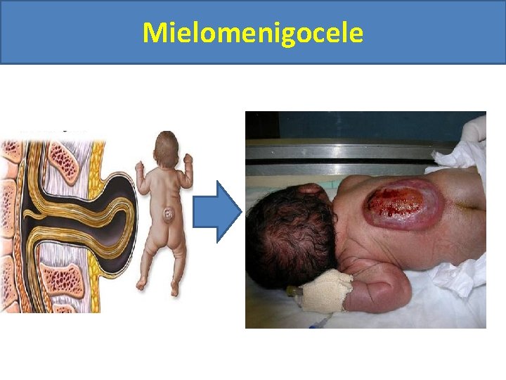 Mielomenigocele 