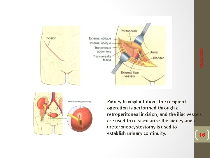10/22/2021 Kidney transplantation. The recipient operation is performed through a retroperitoneal incision, and the