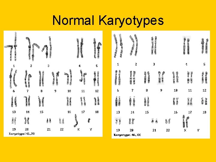 Normal Karyotypes Normal Karyotypes
