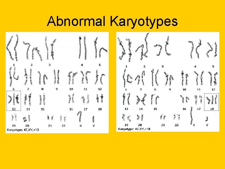 Abnormal Karyotypes Abnormal Karyotypes